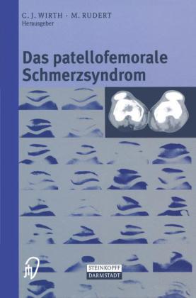 Das patellofemorale Schmerzsyndrom